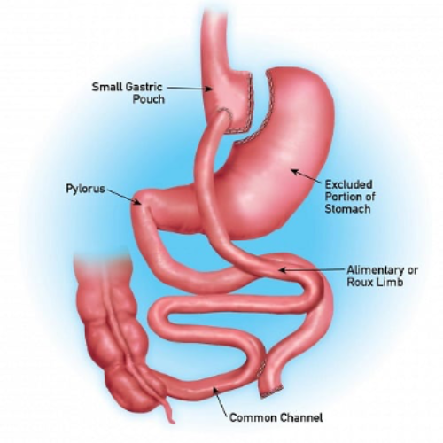 Gastric Bypass