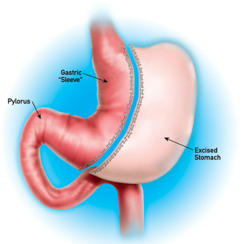 Gastric Sleeve graphic