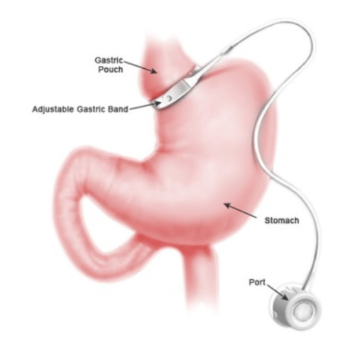 Revision Surgery graphic